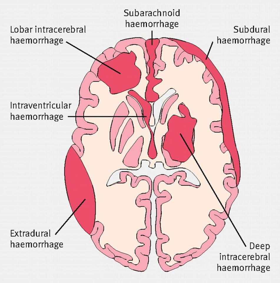 bleeding-within-meninges-and-how-to-treat-it-platform-cme