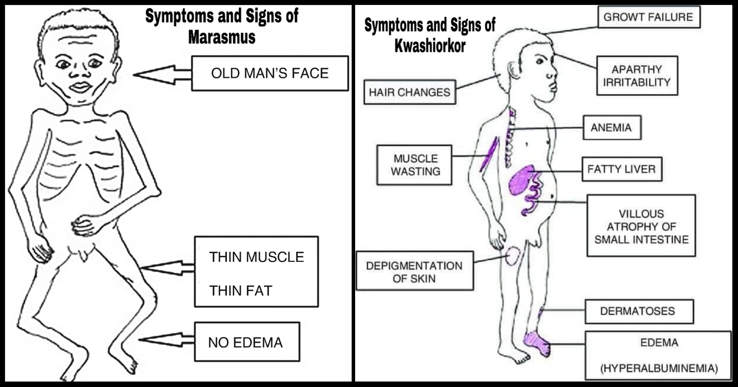 ppt-starvation-and-refeeding-syndrome-powerpoint-presentation-id-671492