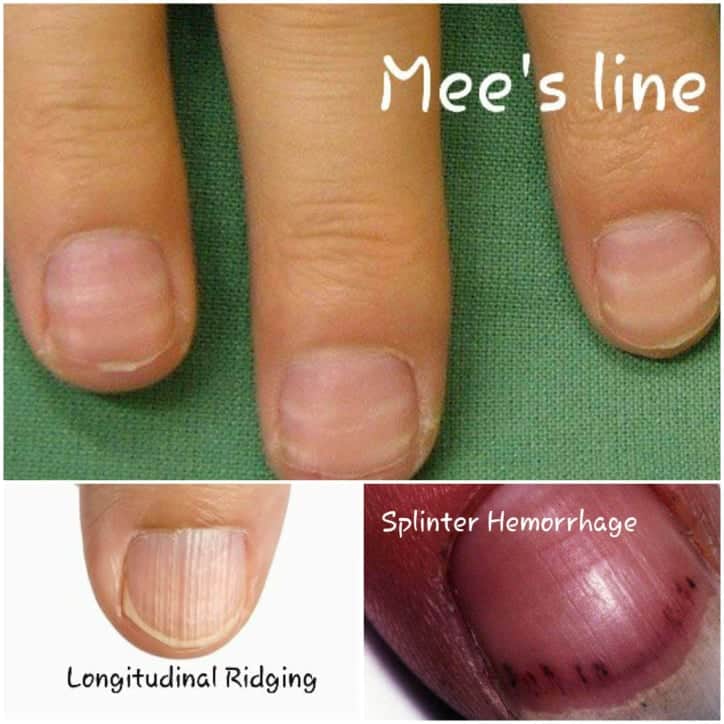 Multiple linear red bands on the fingernails: Idiopathic polydactylous  longitudinal erythronychia