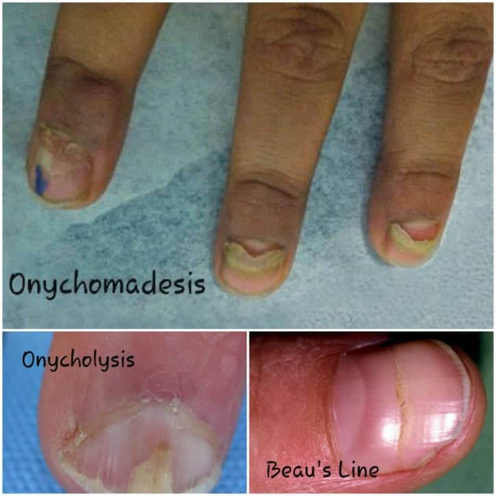 Nail Deformities and Dystrophies - Dermatologic Disorders - Merck Manuals  Professional Edition