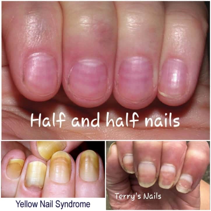 PDF] Nail Disorders in Patients with Chronic Renal Failure | Semantic  Scholar
