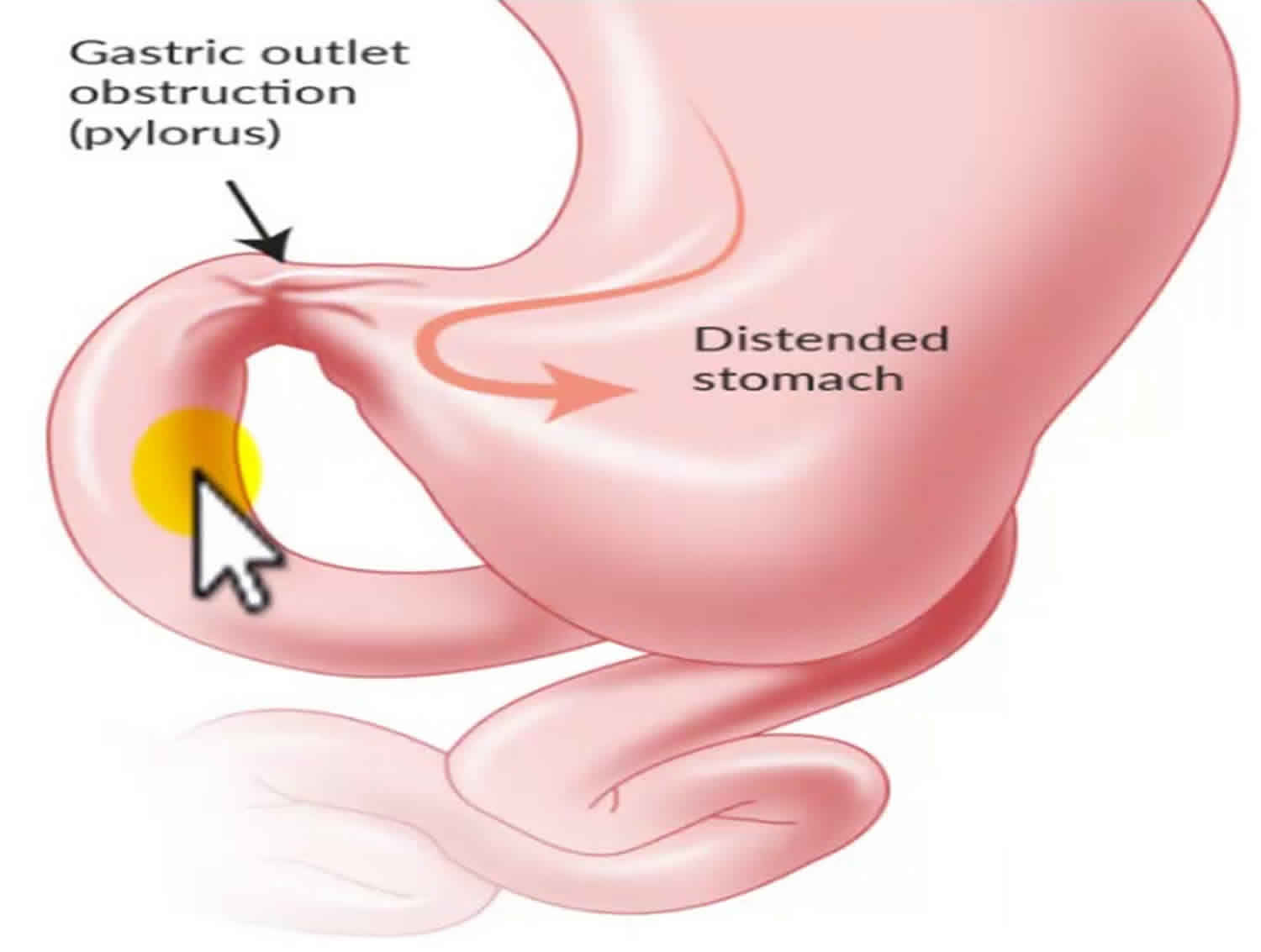 important-discussion-about-gastric-outlet-obstruction-platform-cme