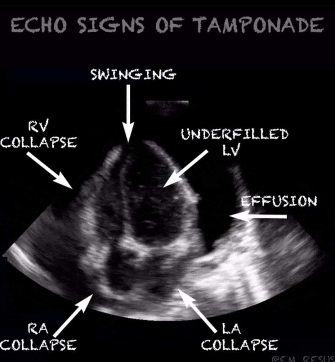 Do you know about Cardiac Tamponade?? Platform CME