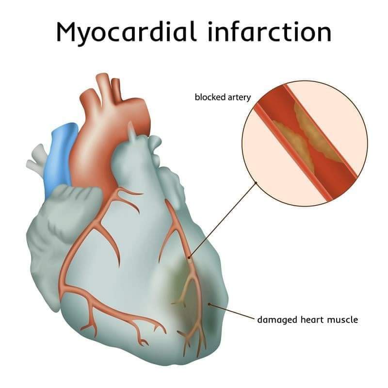 Myocardial Injury