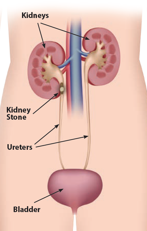 some-important-discussion-about-renal-calculi-platform-cme