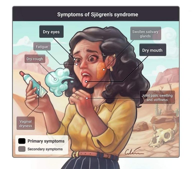 Let’s Know About Primary & Secondary Sjogren Syndrome – Platform | CME