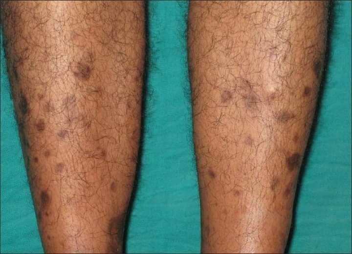 diabetic rash on shins